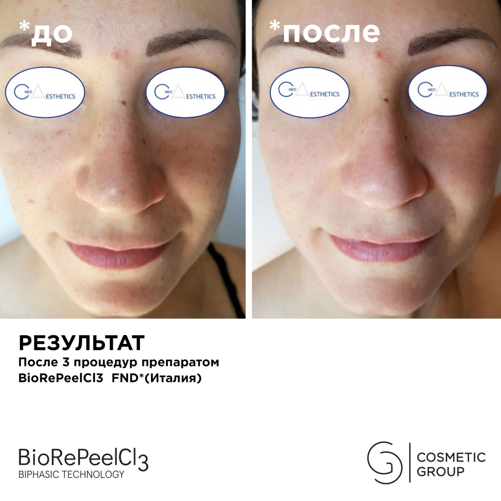 Пилинг BioRePeelCL3